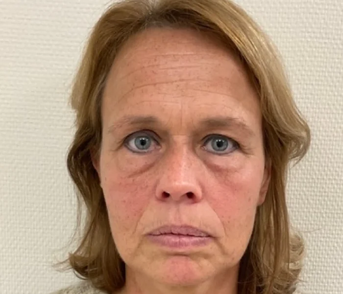Endolift voor