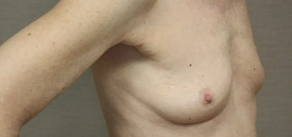Lipofilling voor