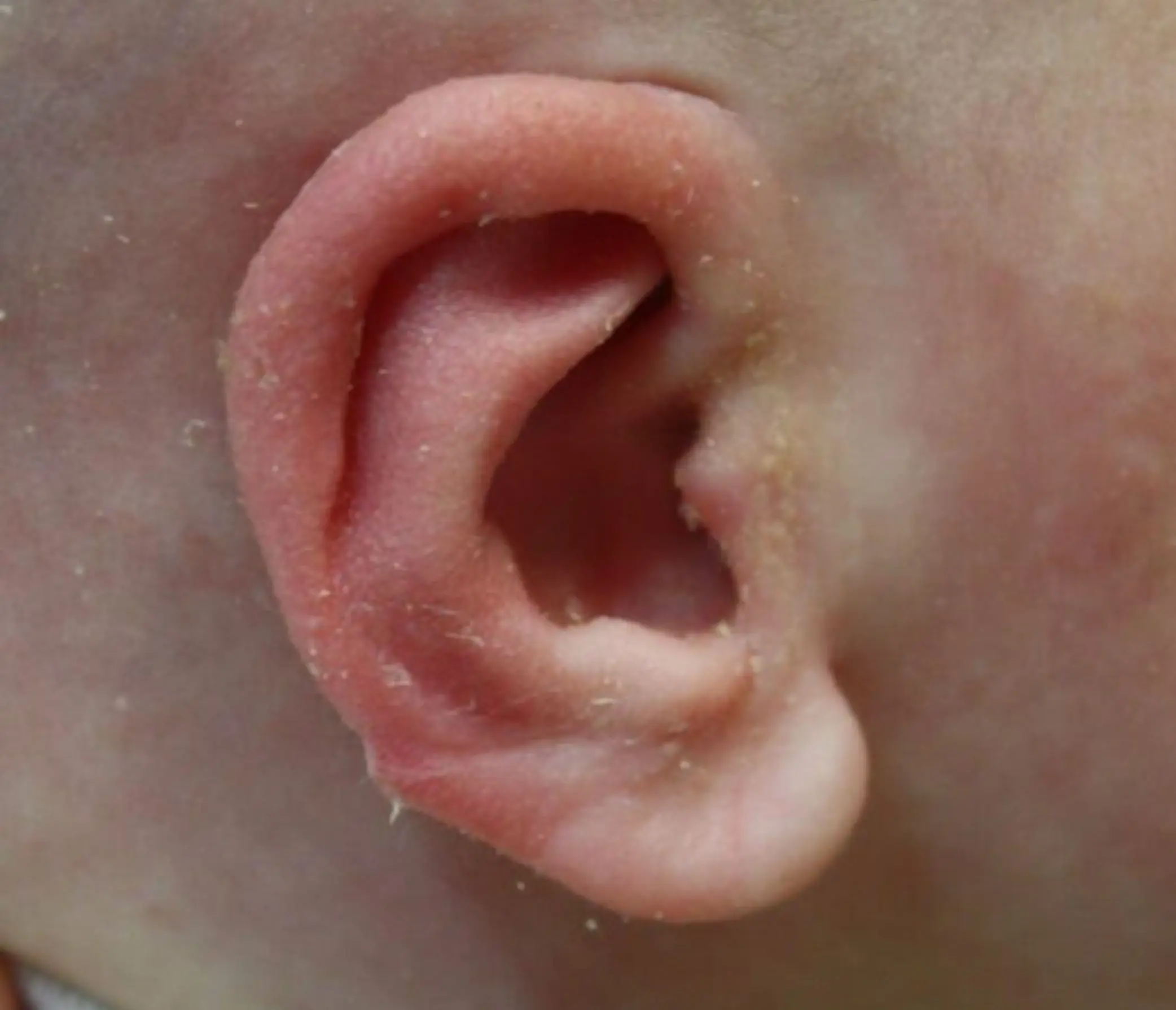 Earwell bij baby's
