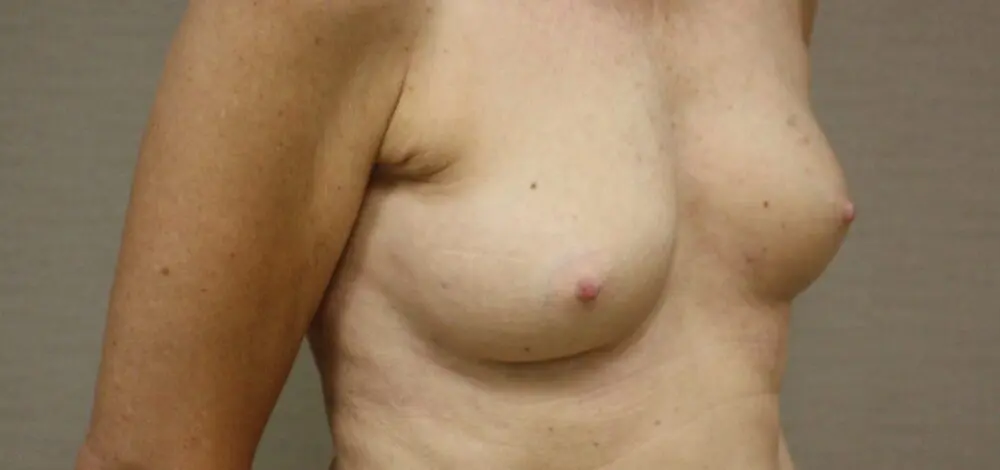 Lipofilling Na