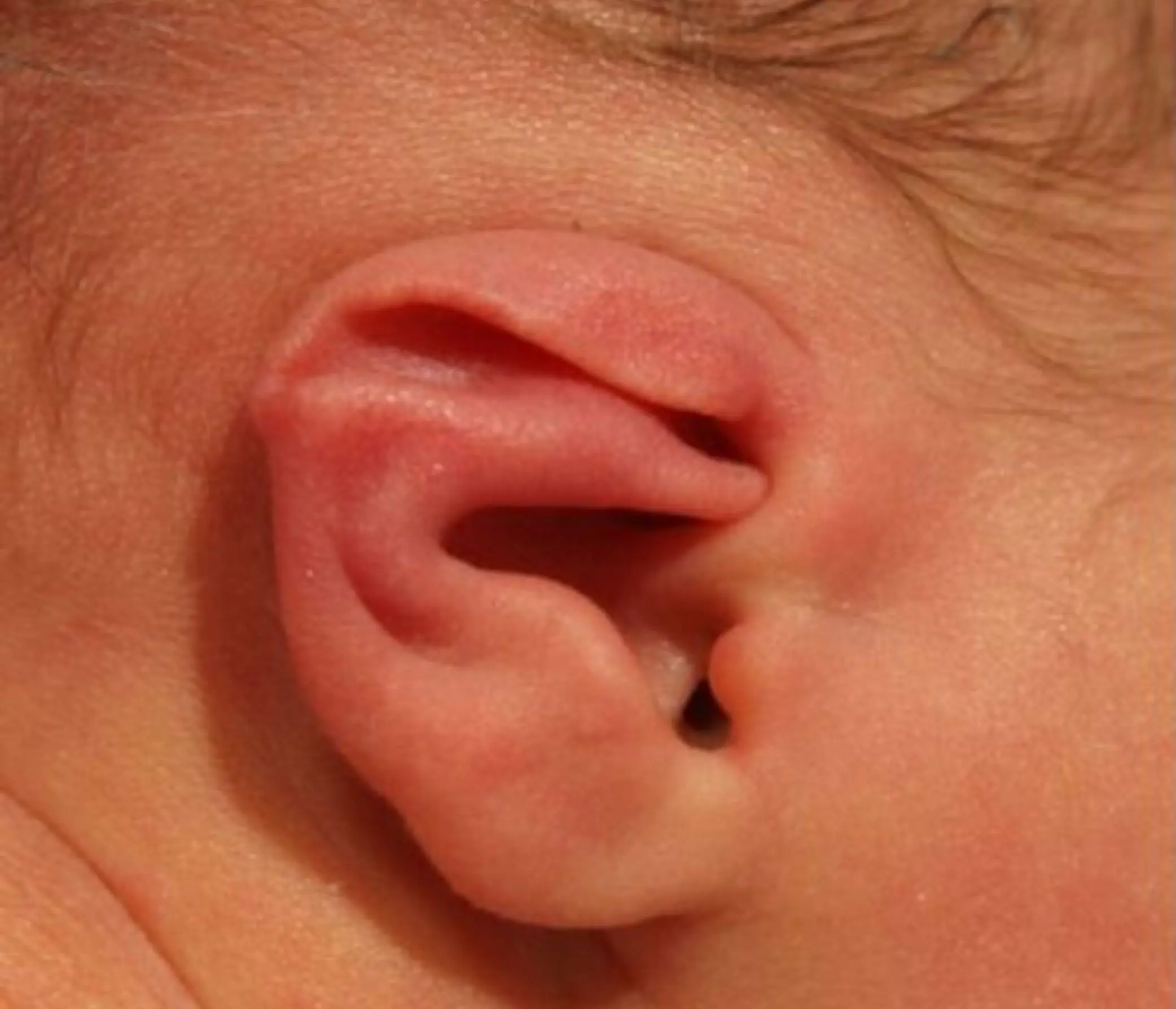 Earwell bij baby's voor