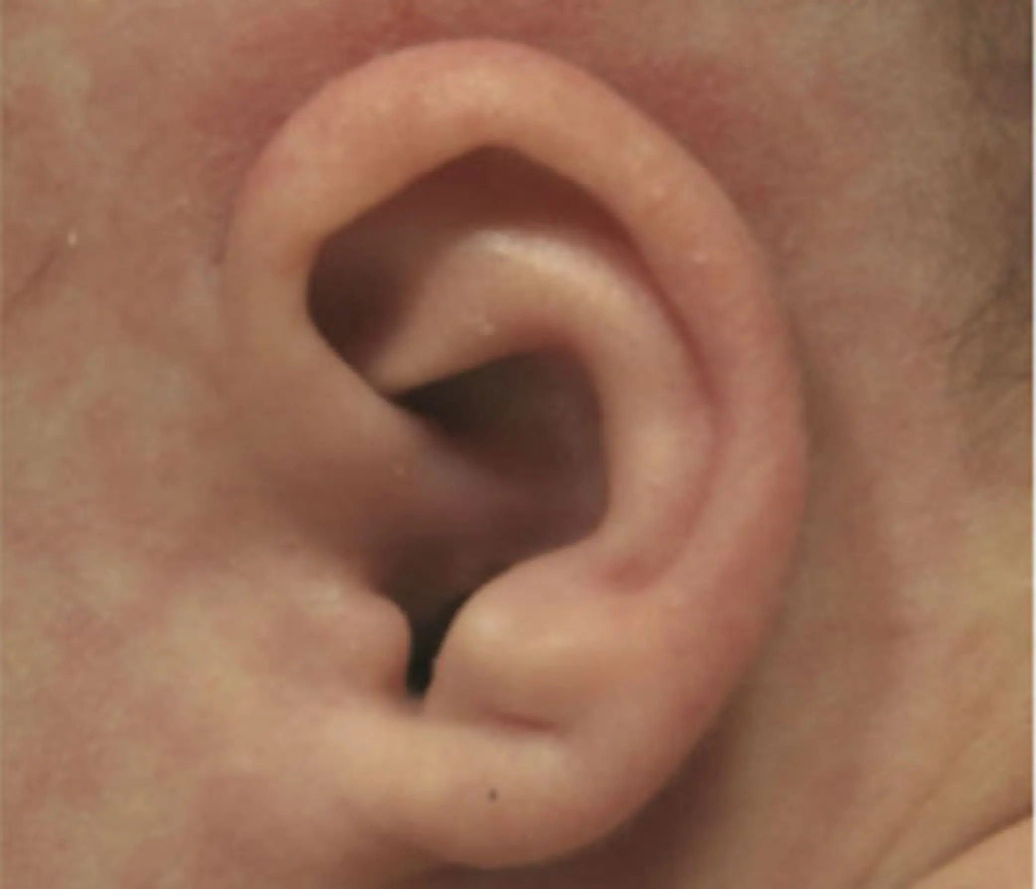 Earwell bij baby's na