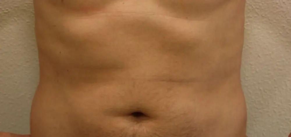 Liposuctie met lipolife na
