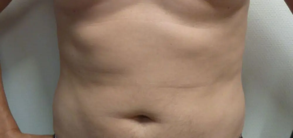Liposuctie met lipolife voor