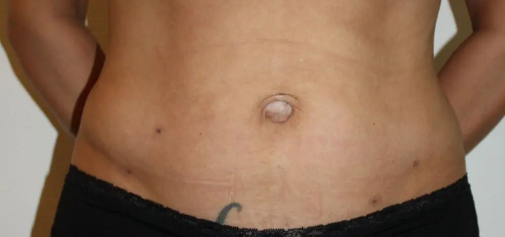 Liposuctie met lipolife na