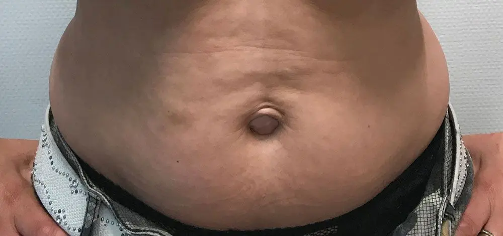 Liposuctie met lipolife voor