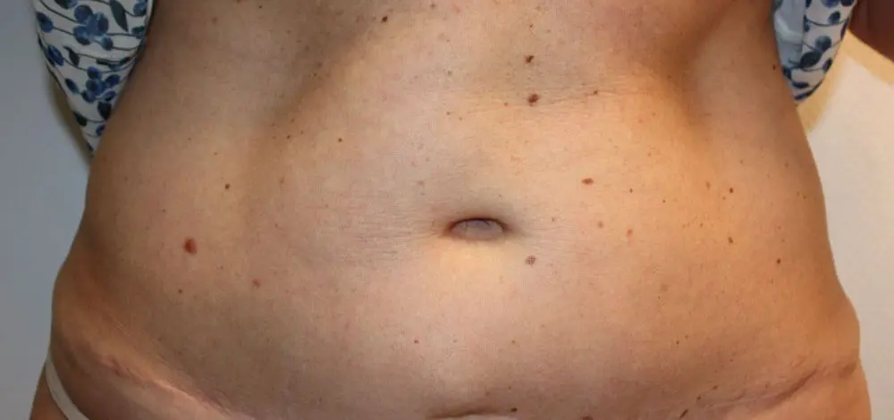 Liposuctie met lipolife voor