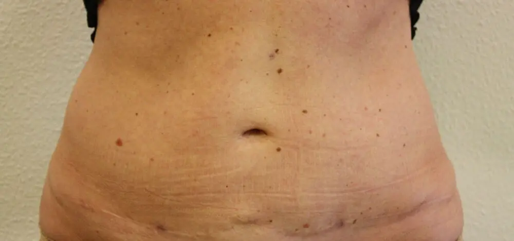Liposuctie met lipolife na