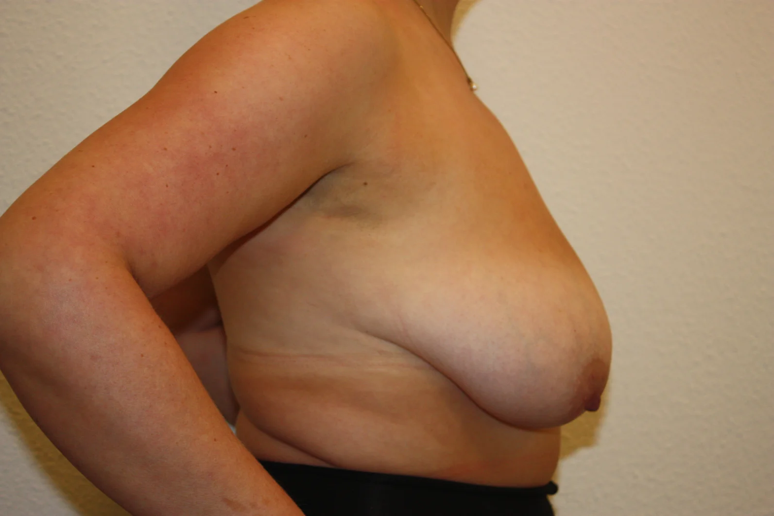 Borstverkleining voor