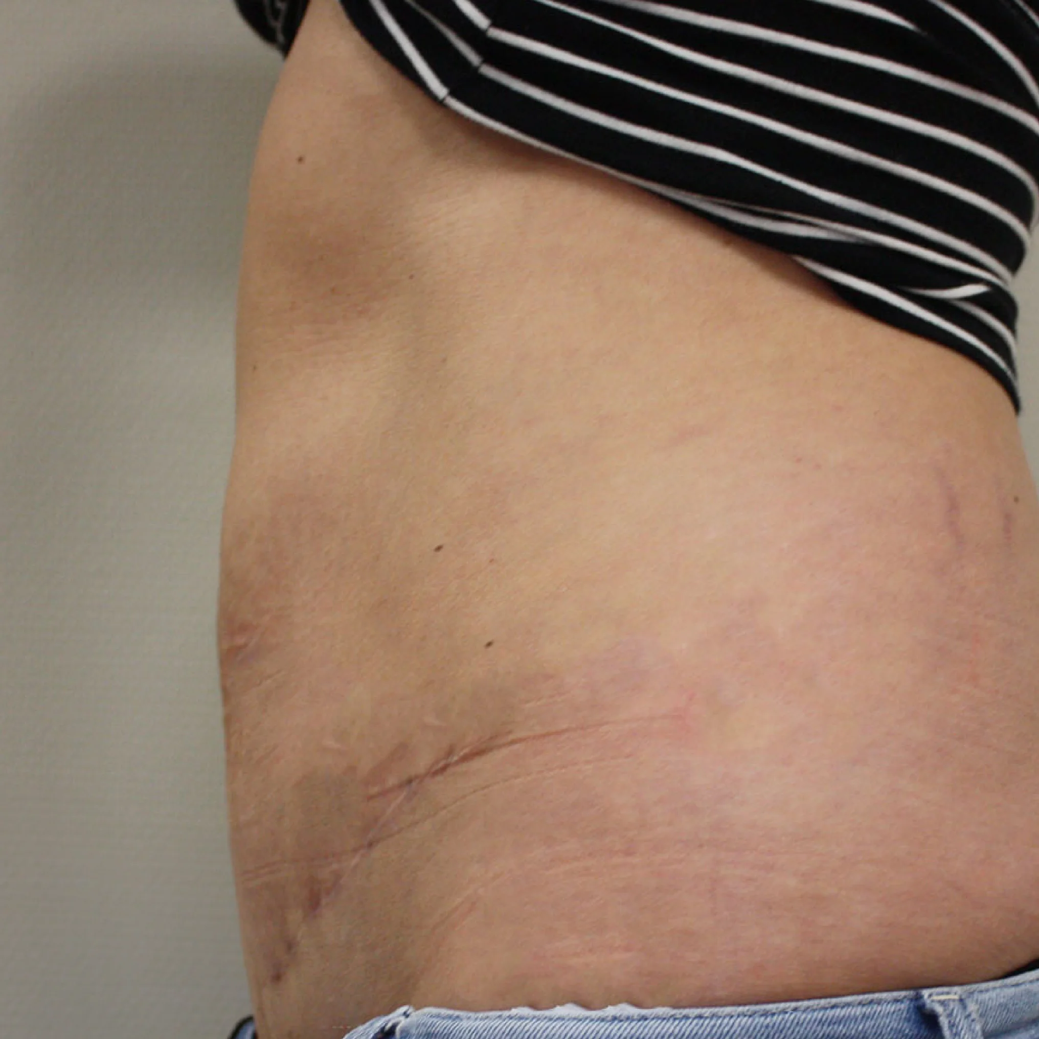 Buikwandcorrectie na