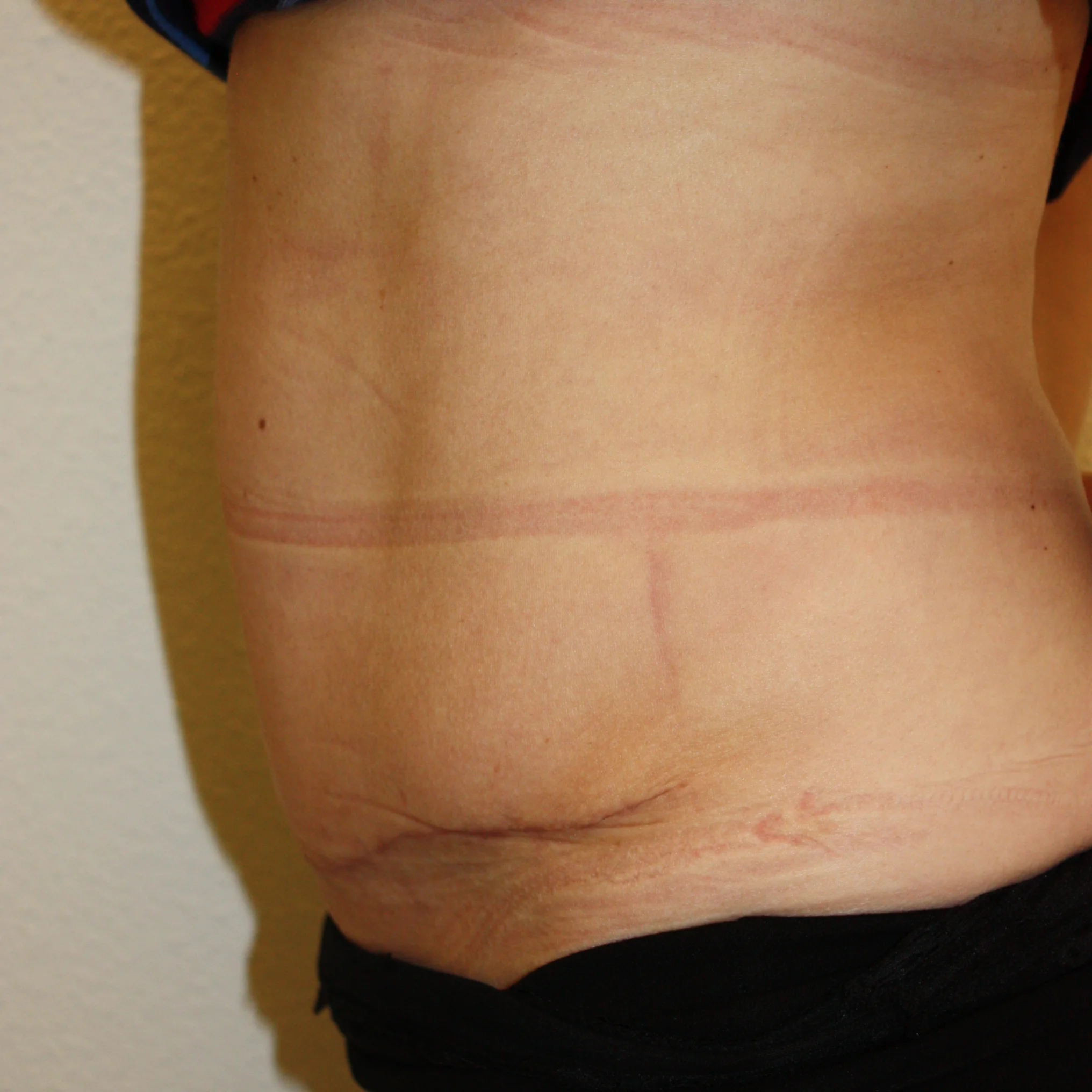 Buikwandcorrectie na