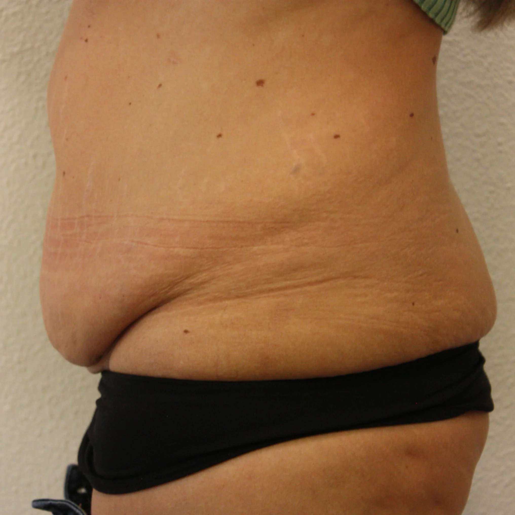 Buikwandcorrectie voor