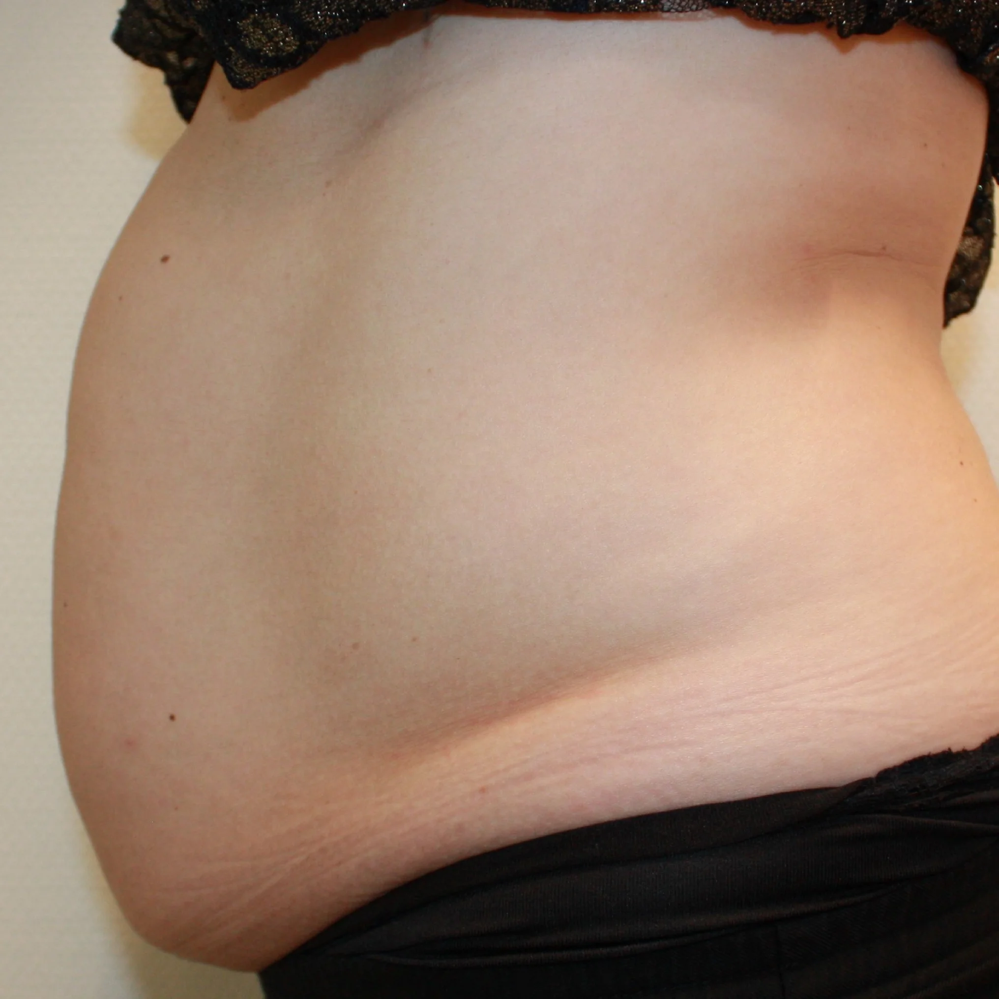 Buikwandcorrectie voor