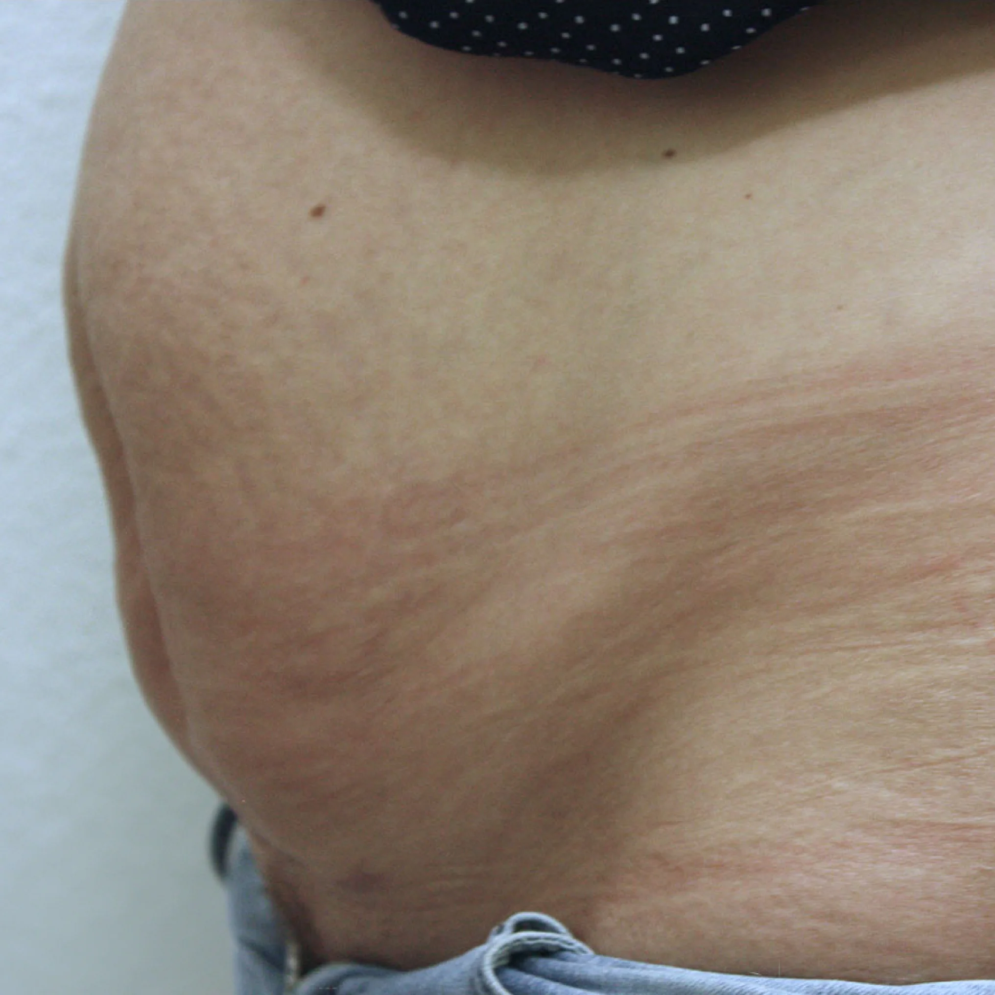 Buikwandcorrectie voor