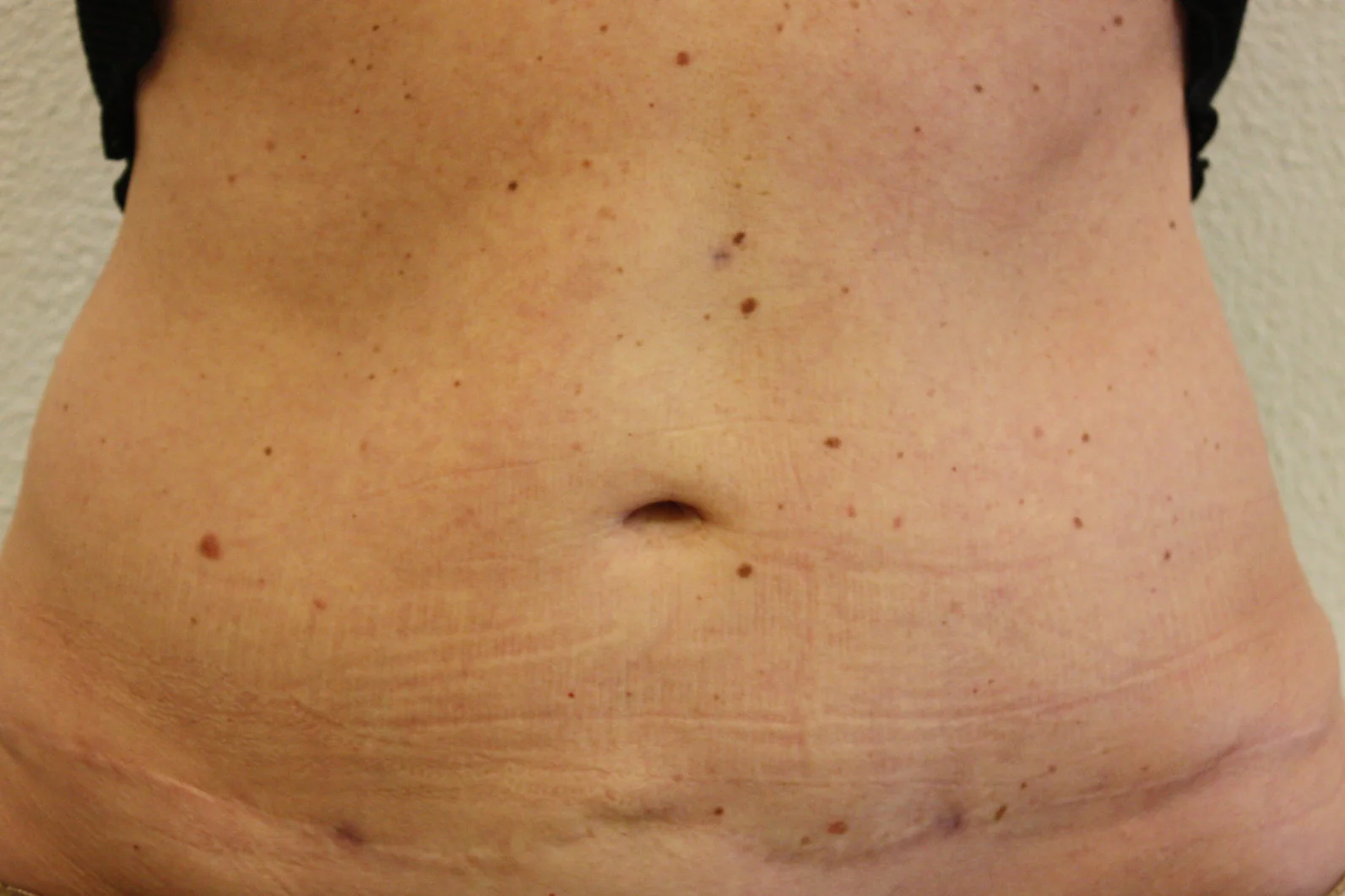 Liposuctie met Lipolife na