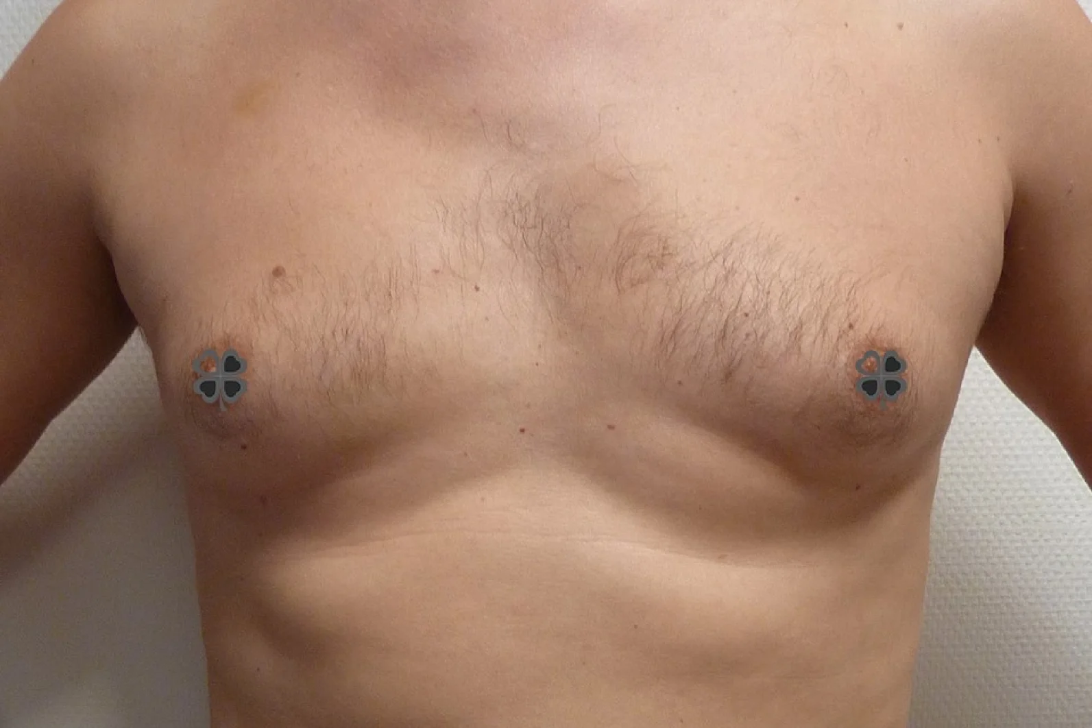 Liposuctie met Lipolife voor