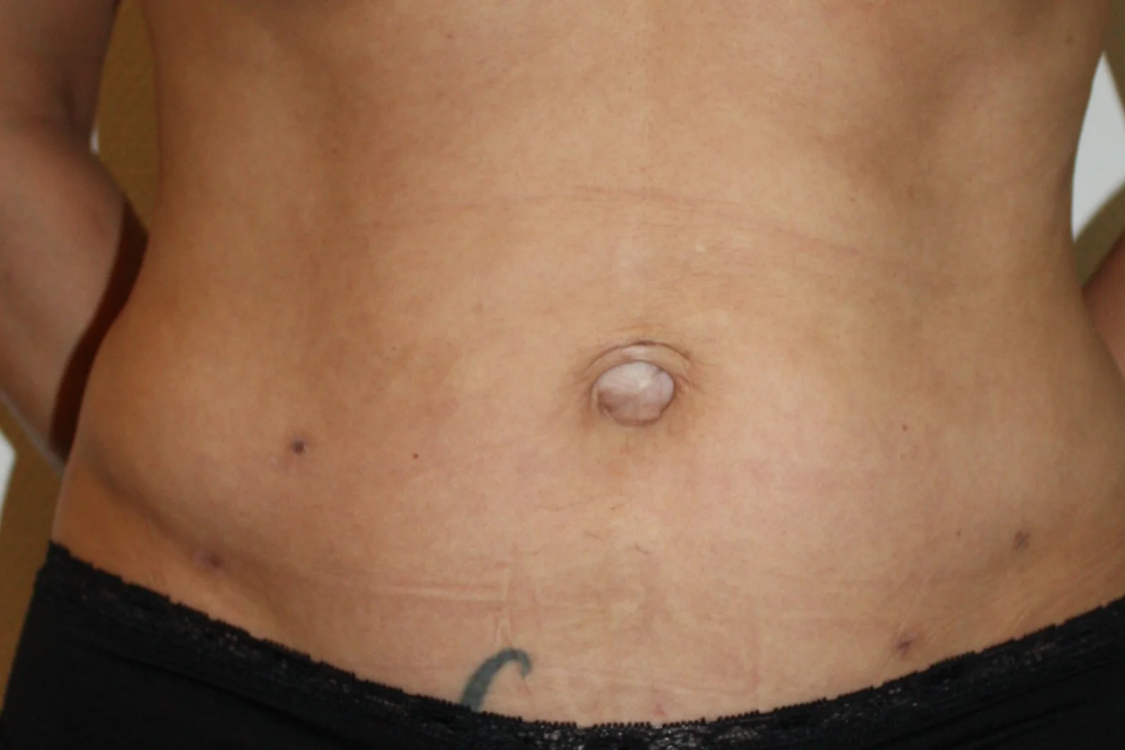 Liposuctie met Lipolife na