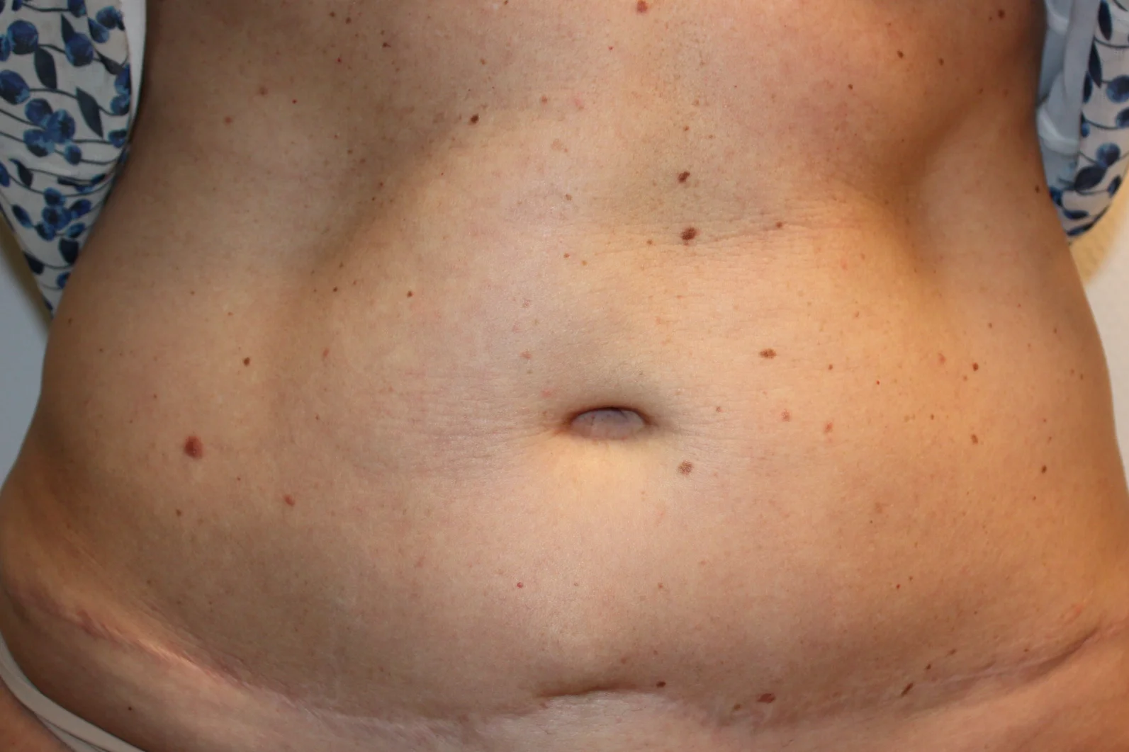 Liposuctie met Lipolife voor