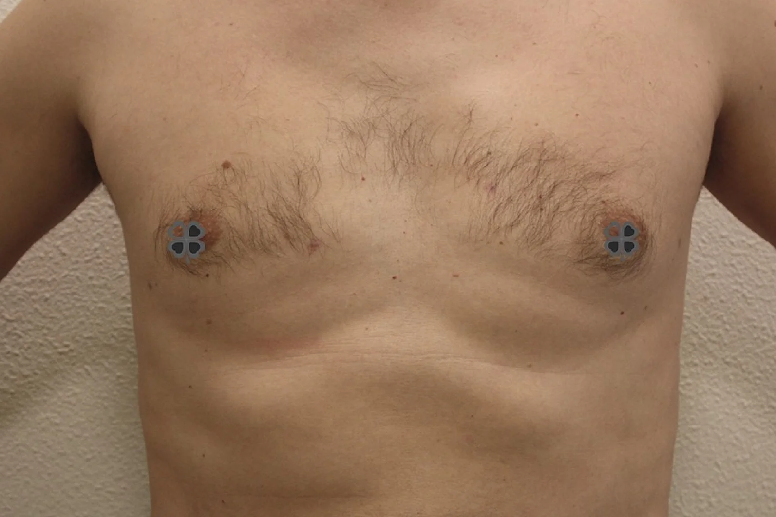 Liposuctie met Lipolife na