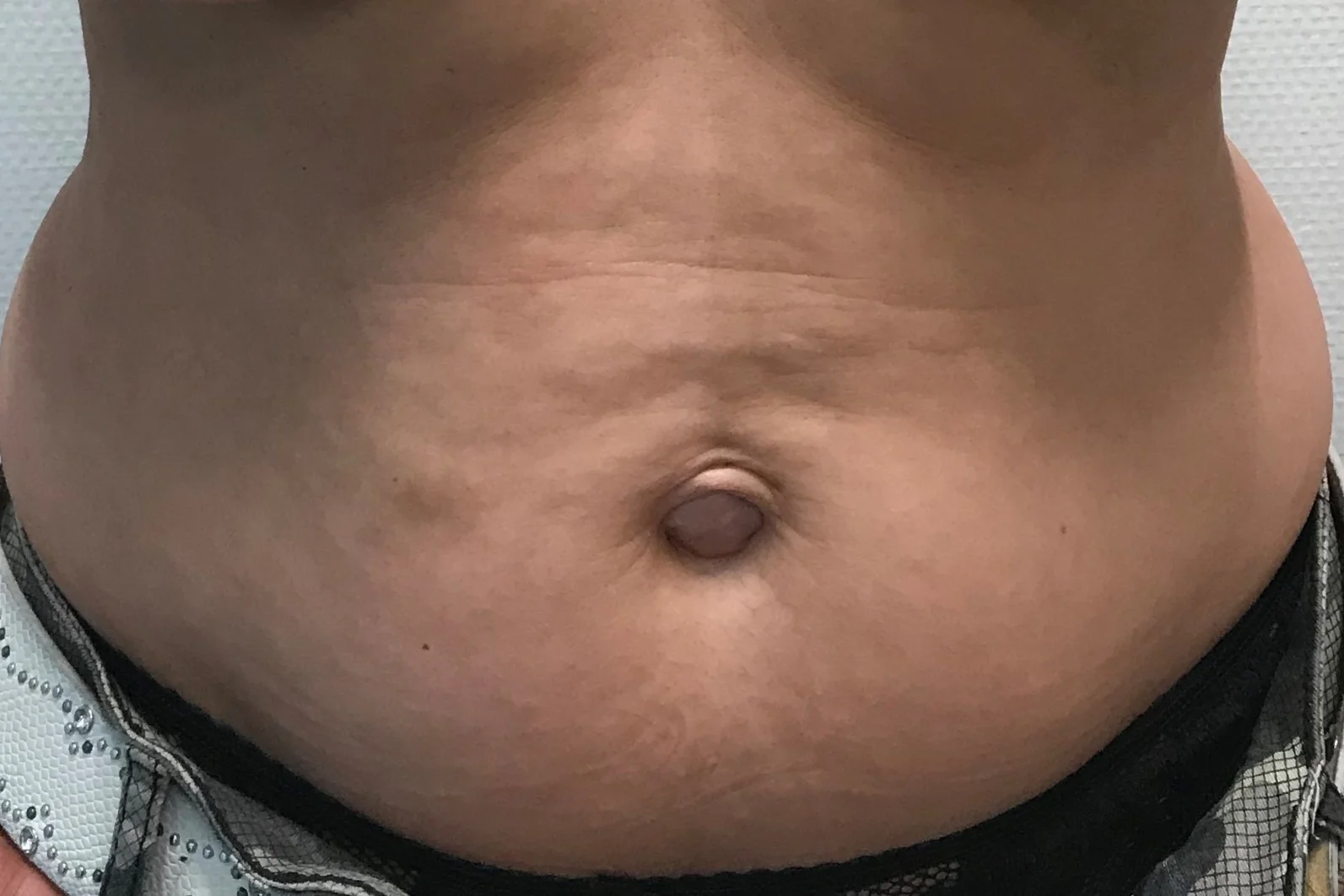 Liposuctie met Lipolife voor