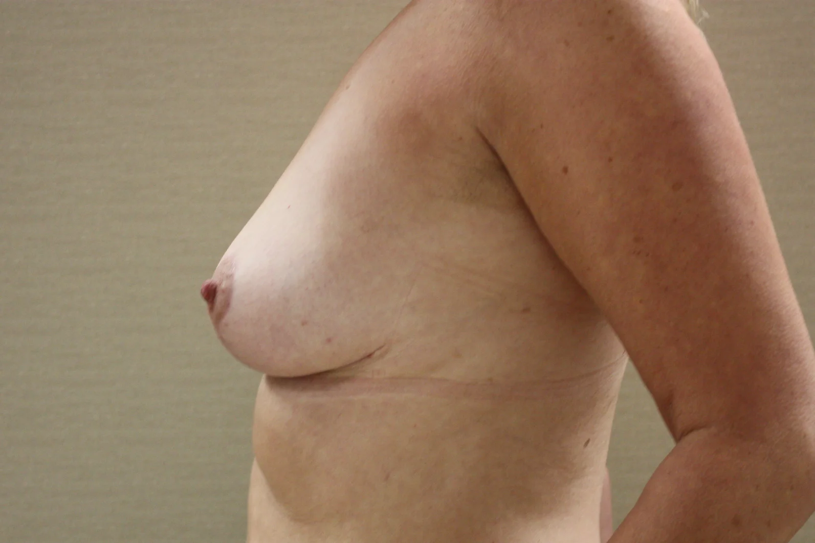 Verwijderen protheses na