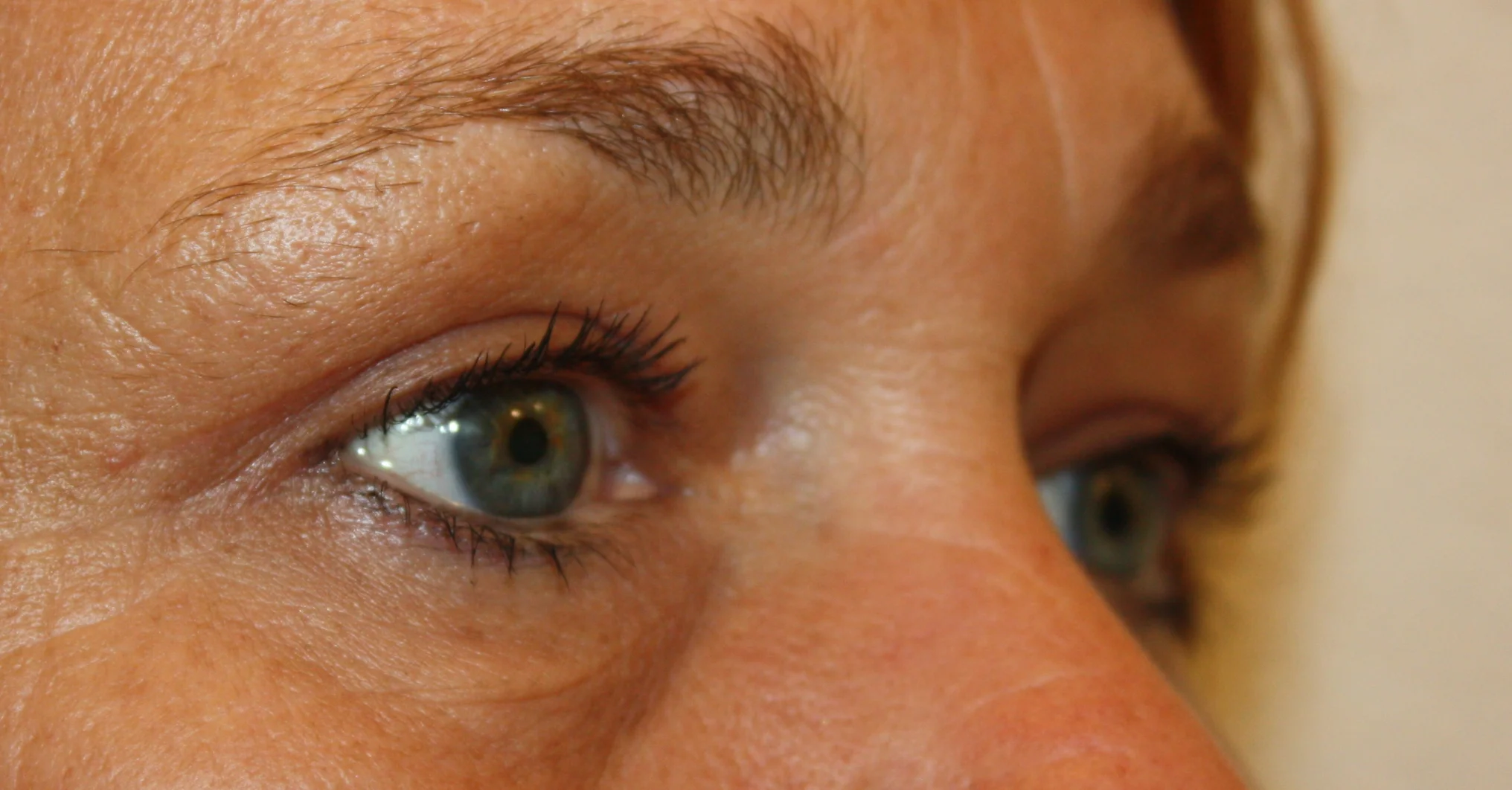 bovenooglidcorrectie na