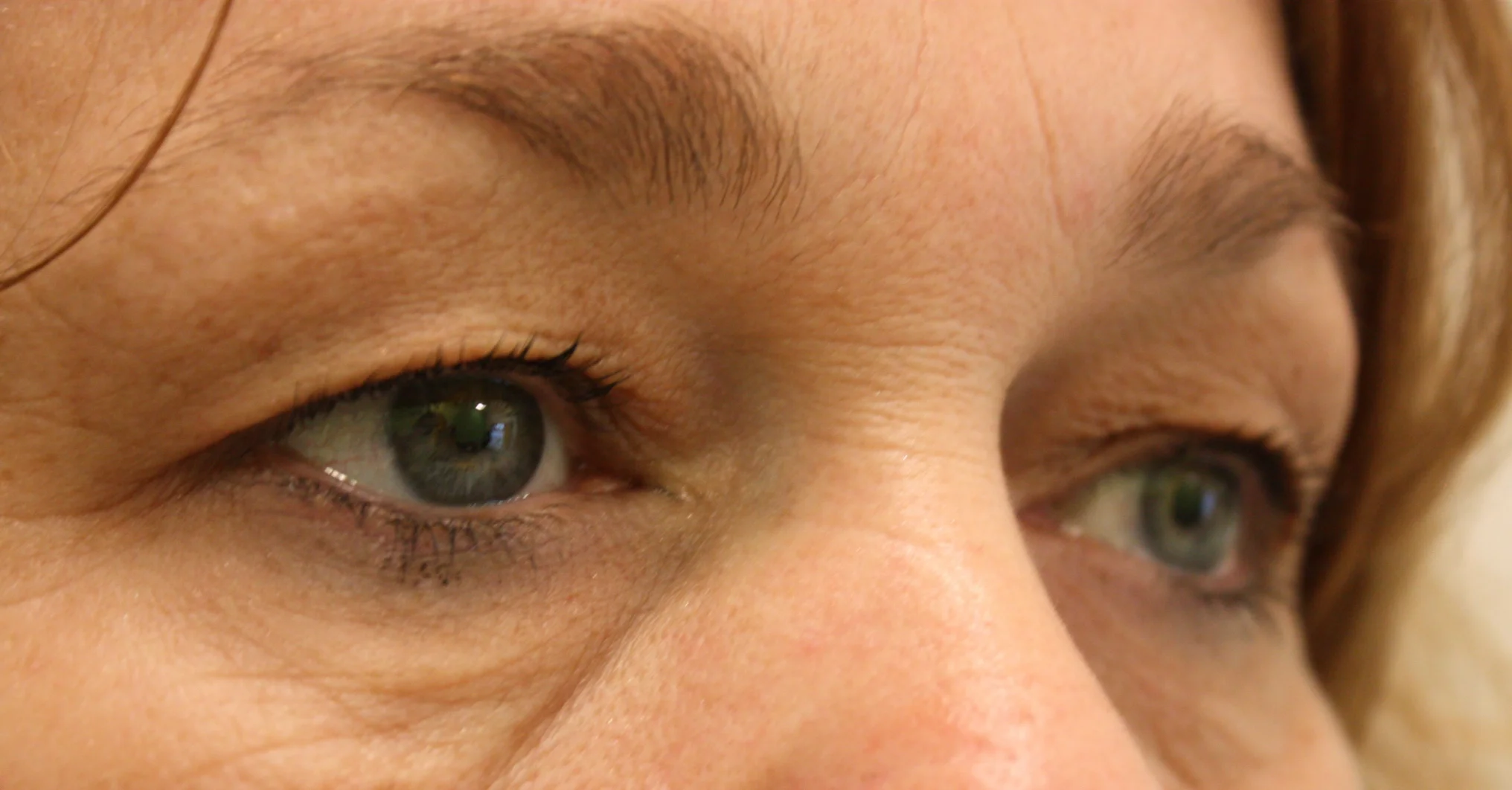 bovenooglidcorrectie voor